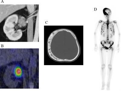ACTH-independent Cushing’s syndrome due to ectopic endocrinologically functional adrenal tissue caused by a GNAS heterozygous mutation: a rare case of McCune–Albright syndrome accompanied by central amenorrhea and hypothyroidism: a case report and literature review